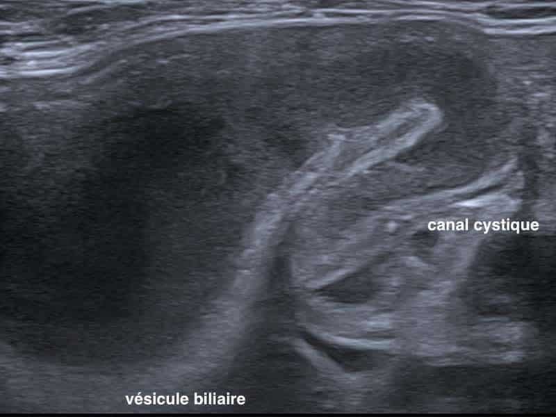 OBSTRUCTION-VOIES-BILAIRES (4)