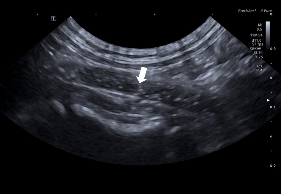 Visualisation de bulles dans l’aorte abdominale – OnlyVet Visualisation de bulles dans l’aorte abdominale (flèche) confirmant le diagnostic de persistance du canal artériel (PCA) avec shunt droit-gauche (shunt dit « inversé »).