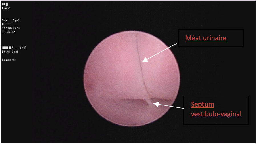 Vestibule et septum vestibulo-vaginal visualisés par cystoscopie – OnlyVet Vestibule et septum vestibulo-vaginal visualisés par cystoscopie - OnlyVet