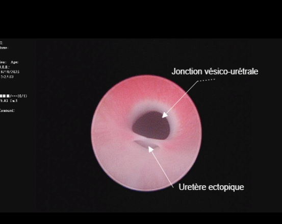 Visualisation de l’uretère ectopique gauche par cystoscopie – OnlyVet Visualisation de l’uretère ectopique gauche par cystoscopie - OnlyVet