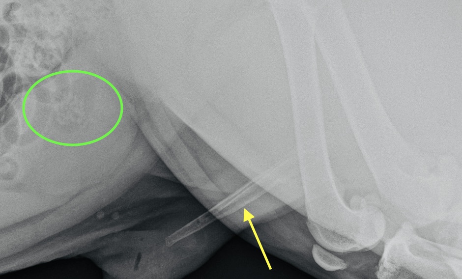 figure 1b - radiographie après urohydropulsion rétrograde, montrant les calculs dans la vessie.