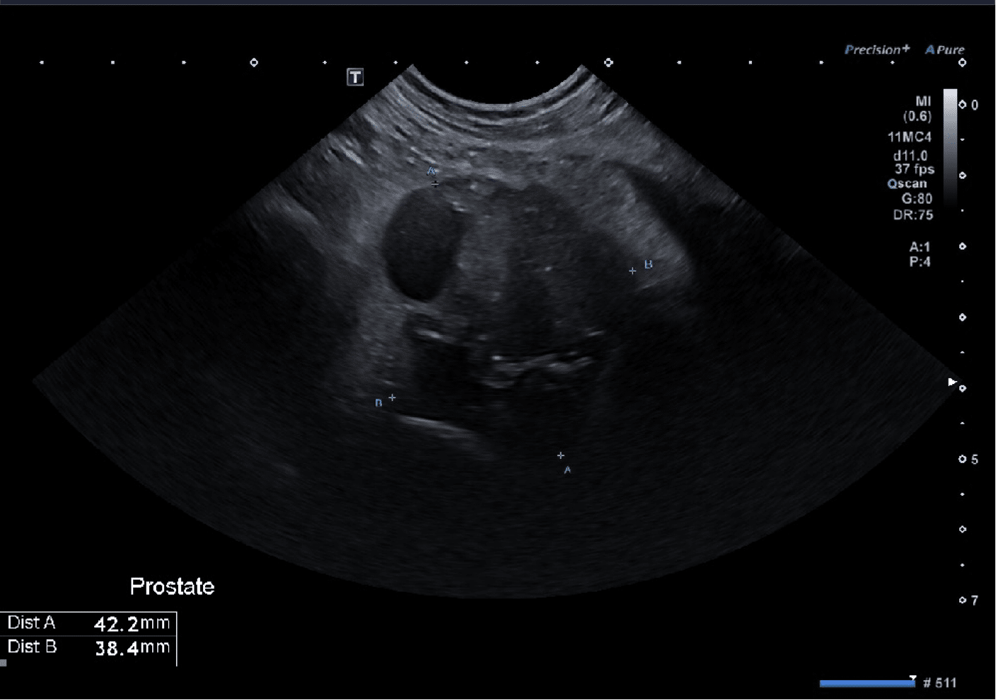 Prostate visualisée à l’échographie abdominale