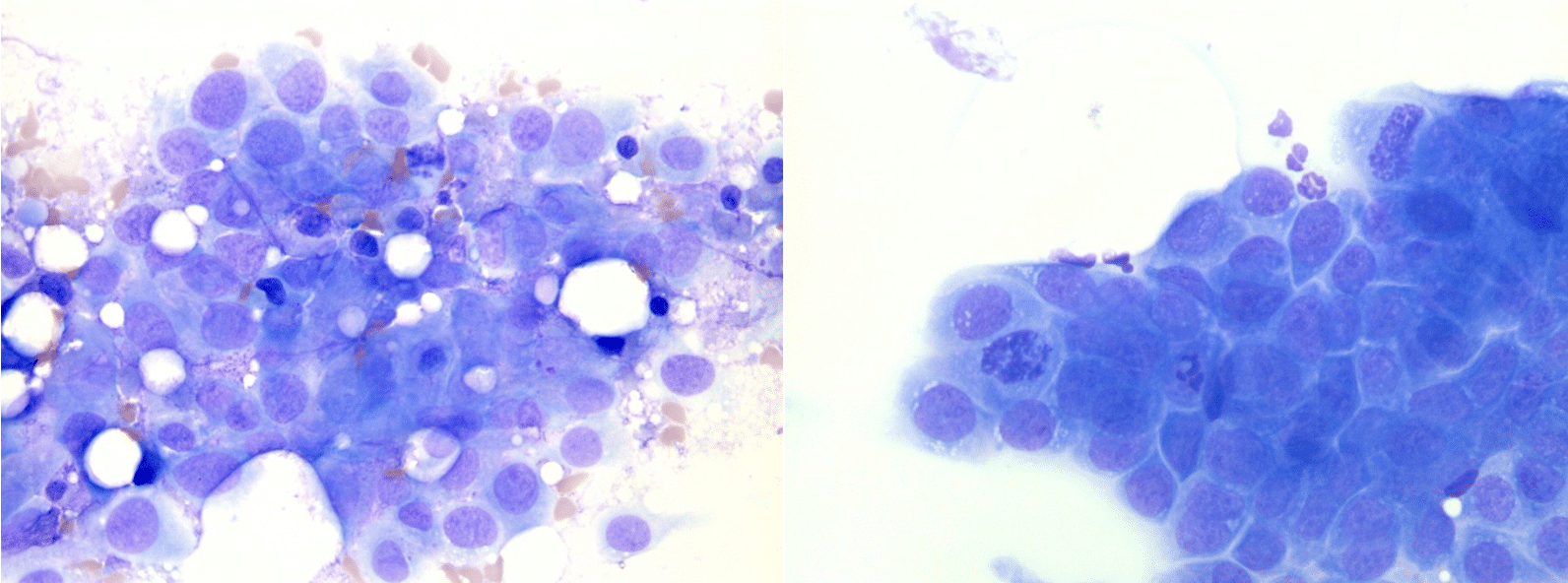 Analyse cytologique des cytoponctions échoguidées à l’aiguille fine de la prostate