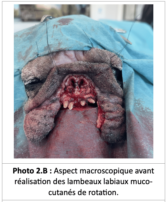 Aspect macroscopique avant réalisation des lambeaux labiaux muco-cutanés de rotation.