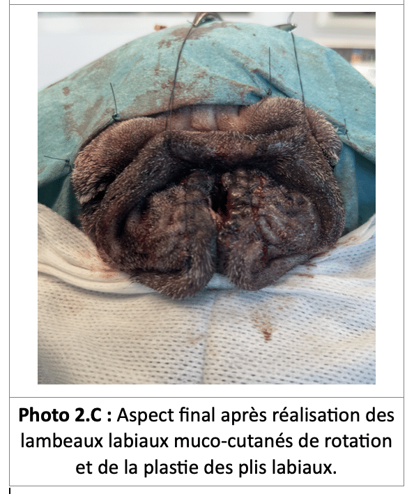 Aspect final après réalisation des lambeaux labiaux muco-cutanés de rotation et de la plastie des plis labiaux.