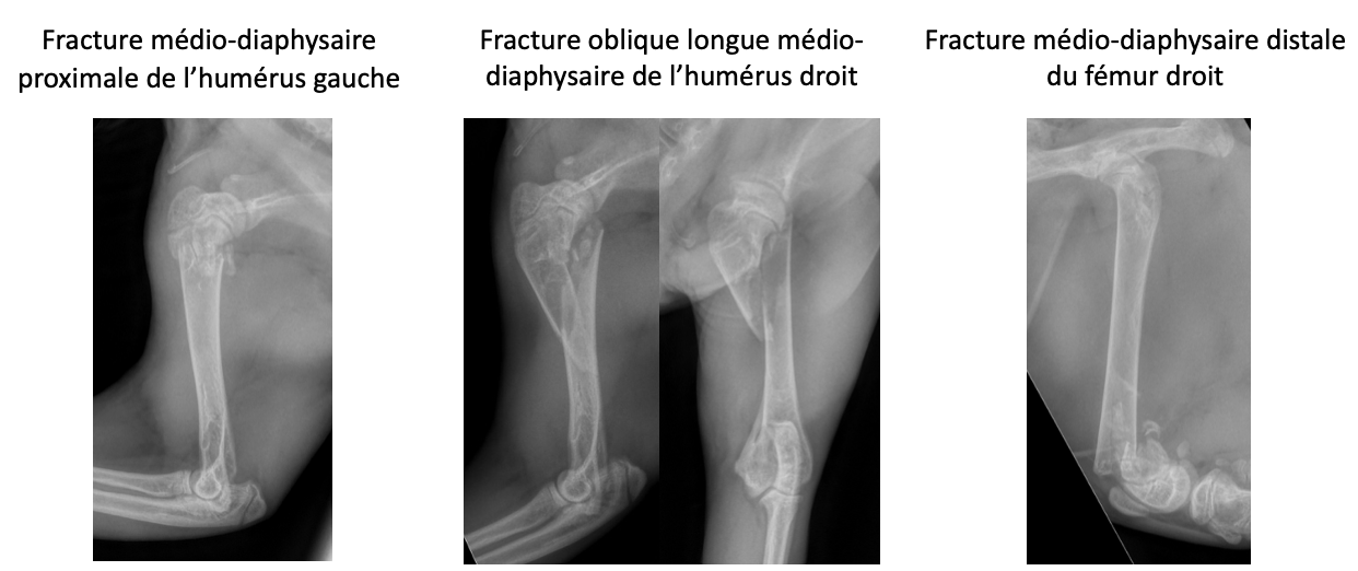 Radio hyperparathyroïdie secondaire