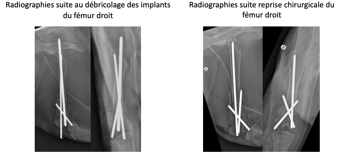 Radiographies suite au débricolage des implants du fémur droit Radiographies suite au débricolage des implants du fémur droit