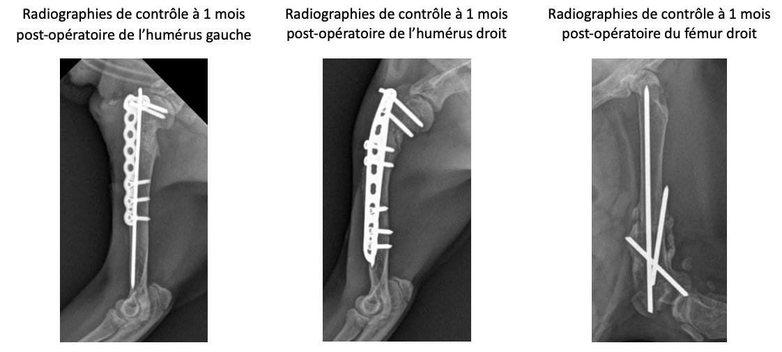 Radiographies de contrôle à 1 mois post-opératoire de l’humérus gauche Radiographies de contrôle à 1 mois post-opératoire de l’humérus gauche