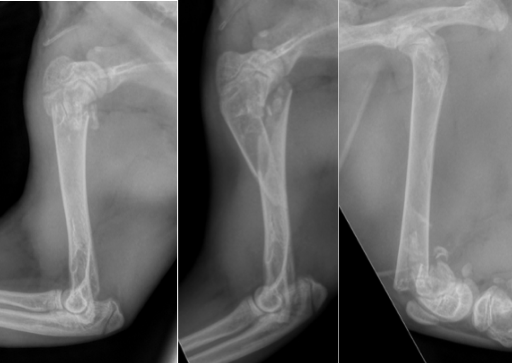 multiples fractures dans un contexte d’hyperparathyroïdie secondaire